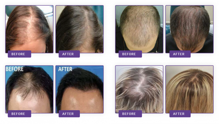 Anti hair loss therapy